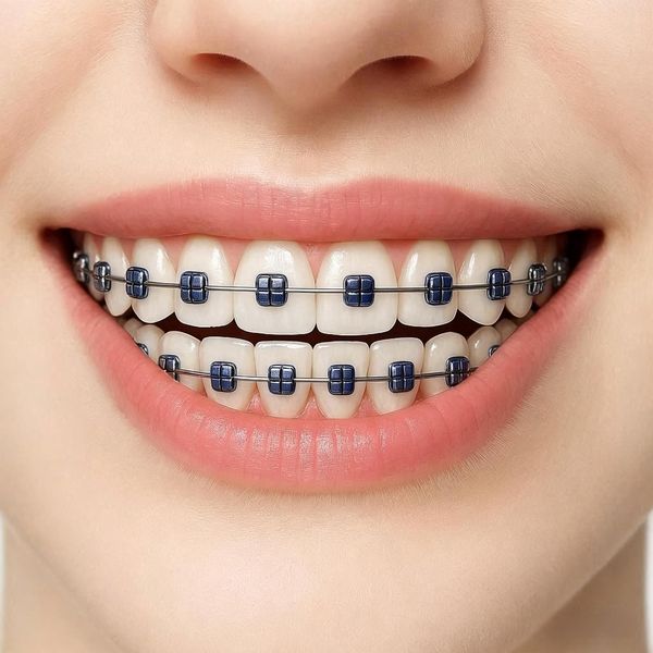 Navy Blue braces color preview on real teeth