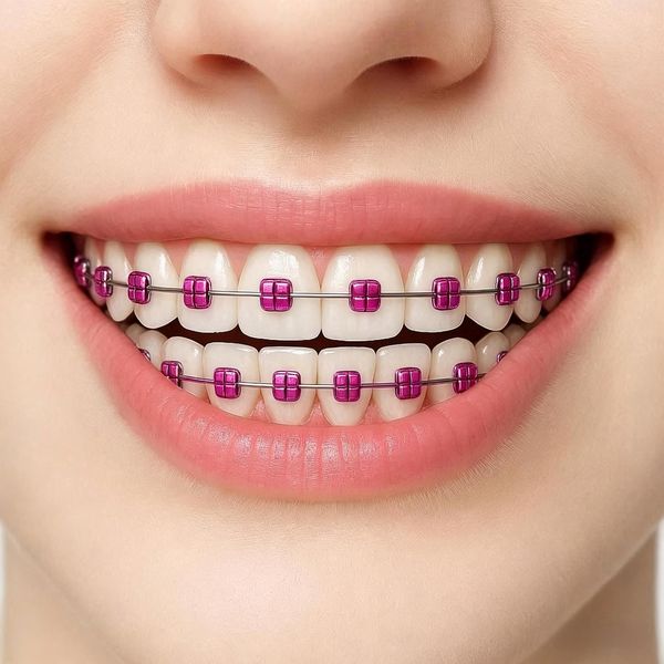 Purple braces color preview on real teeth